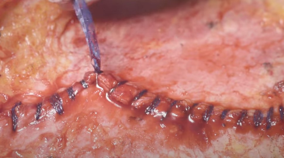 DIEP Flap Closure with Duramesh™ Mesh Suture - From Eurosurgical
