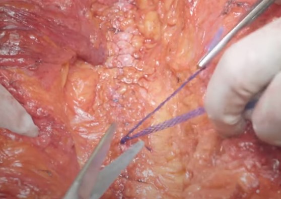 Duramesh Mesh Suture - Incisional Hernia Repair - from Eurosurgical