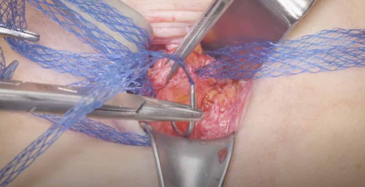 Duramesh Umbilical Hernia Repair - available from Eurosurgical