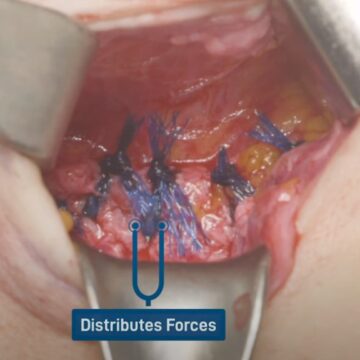 Umbilical Hernia Repair - available from Eurosurgical