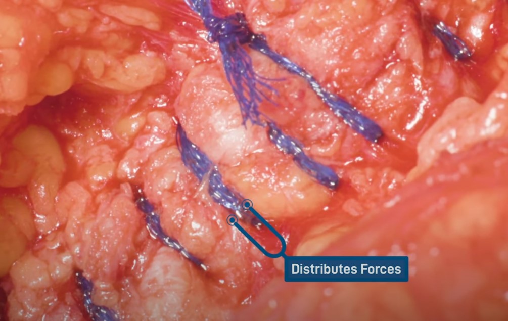 Laparotomy using Duramesh™ Mesh Suture from Eurosurgical